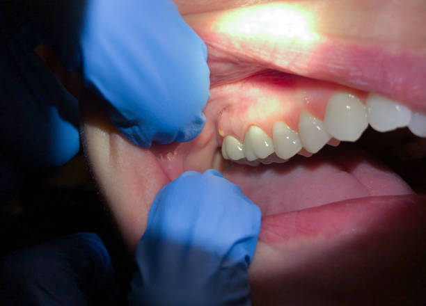 Best Emergency Dentist for Lost Fillings or Crowns in Mount Airy, NC